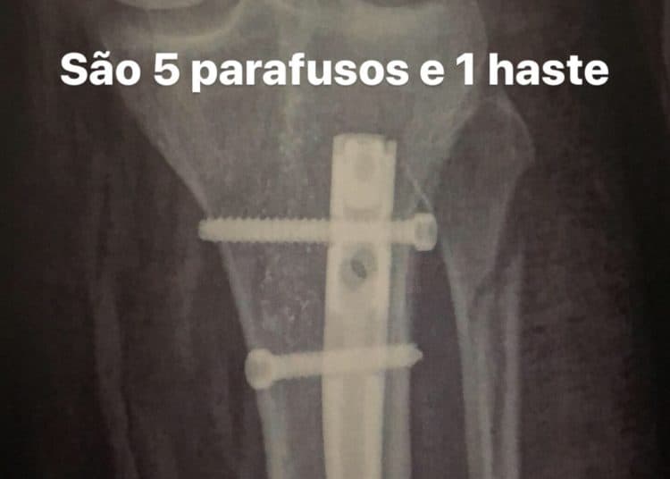 fratura na tibia