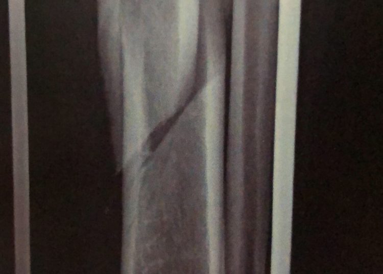 fratura na tibia