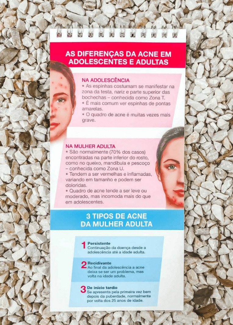 acne na mulher adulta diferenças